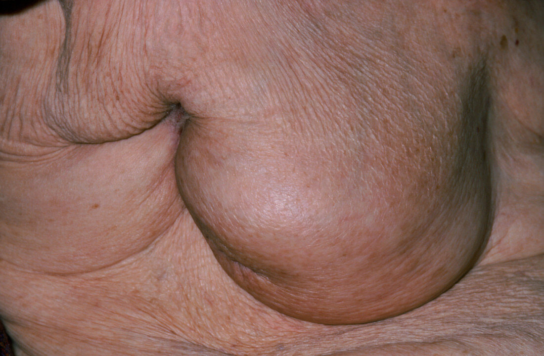 Breast cancer in 80-year-old woman