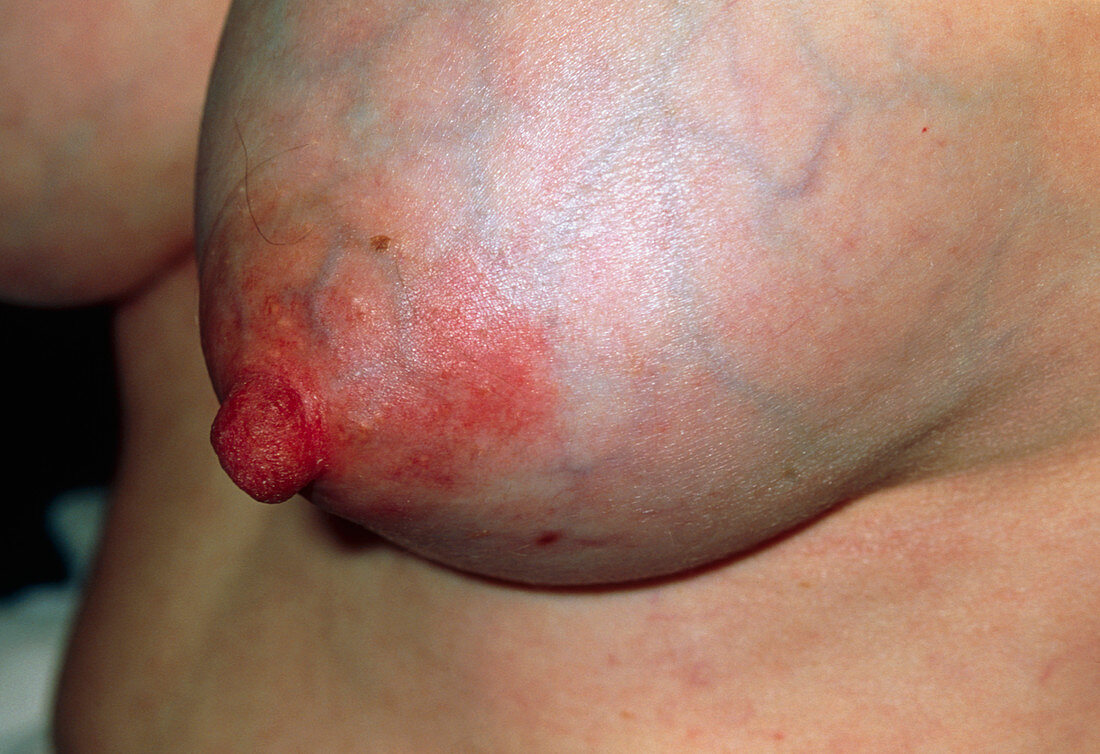 Inflamed breast due to mastitis in breast feeding