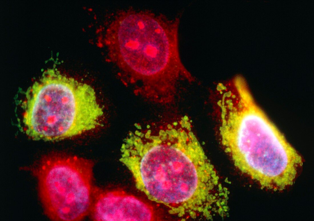 Immunofluorescent LM of breast cancer cell culture