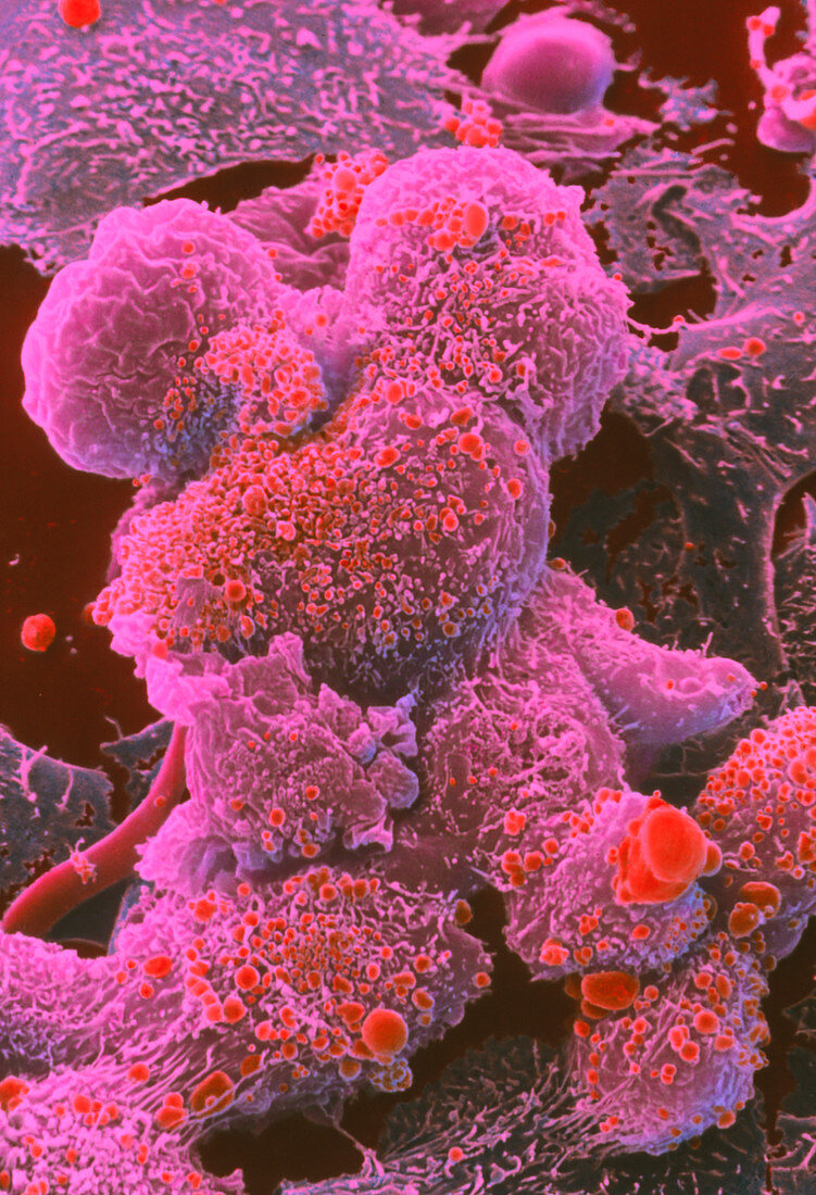 Coloured SEM of breast cancer cells