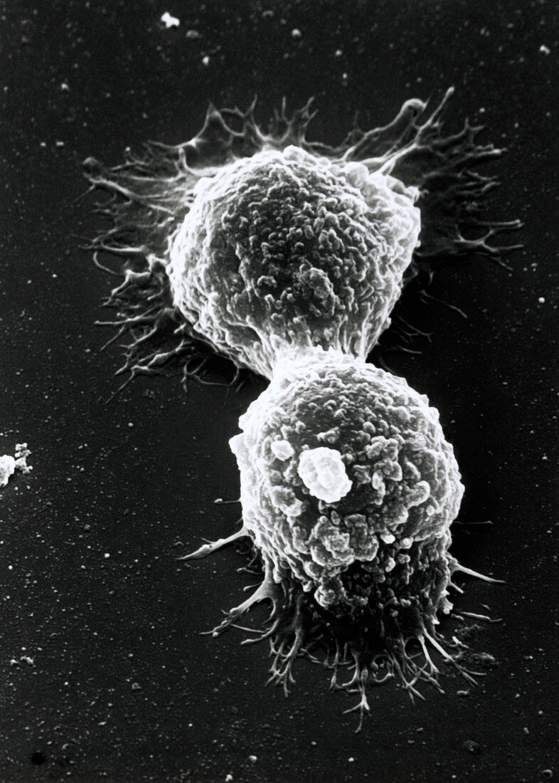 SEM of breast cancer cells dividing