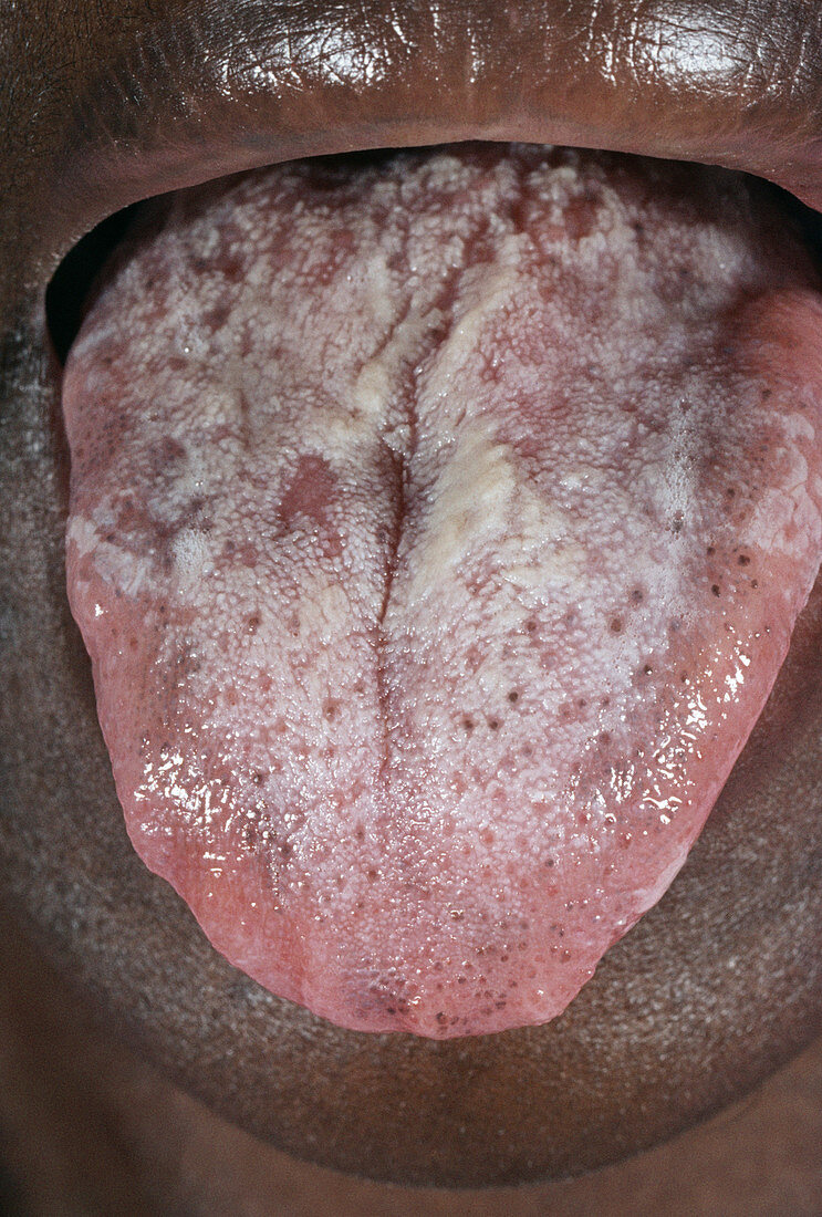 AIDS man with a hairy tongue
