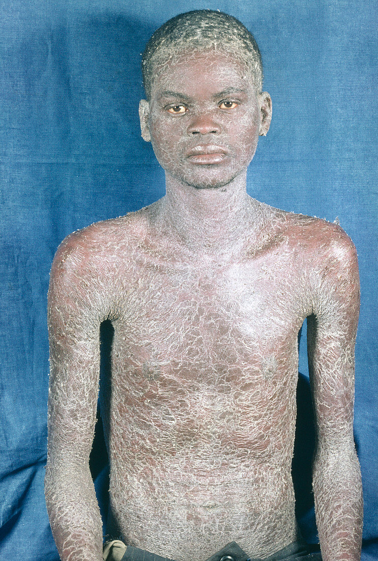 AIDS man with psoriasis
