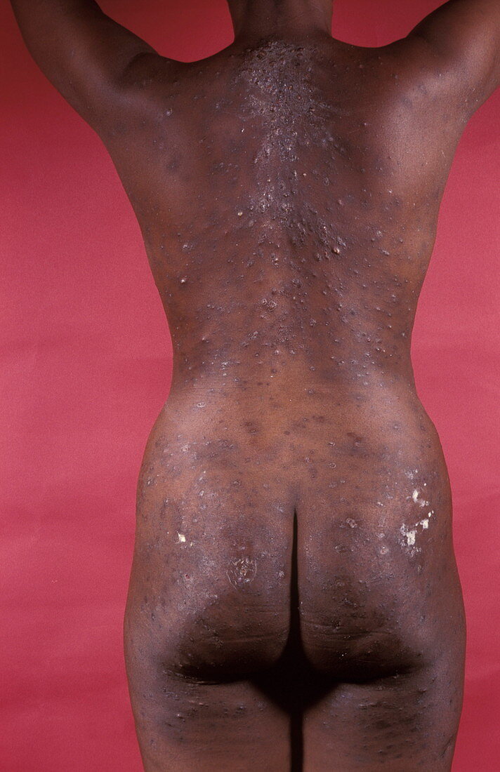 Skin disease in AIDS