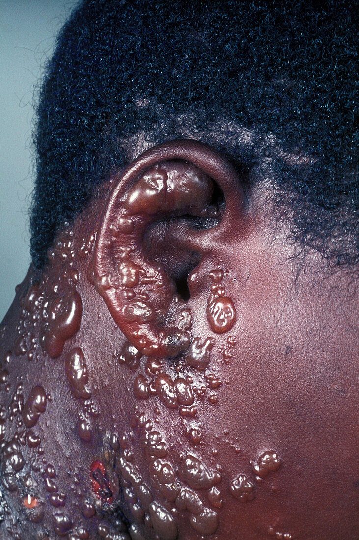 Shingles rash in an HIV patient