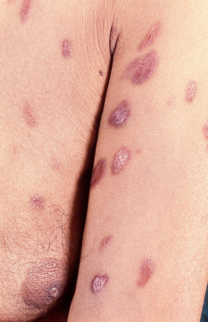 Skin plaques