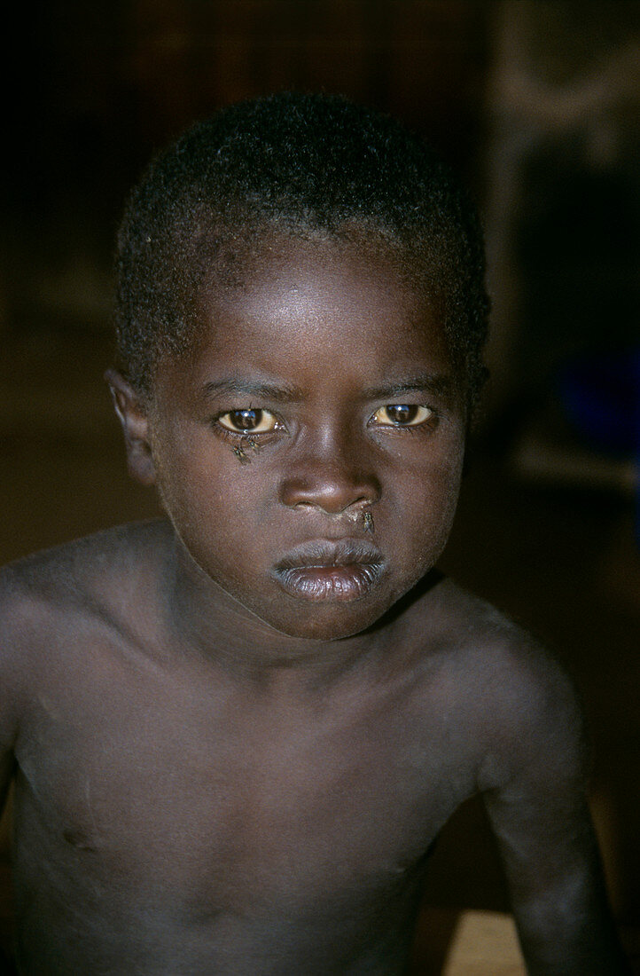 Young child with AIDS