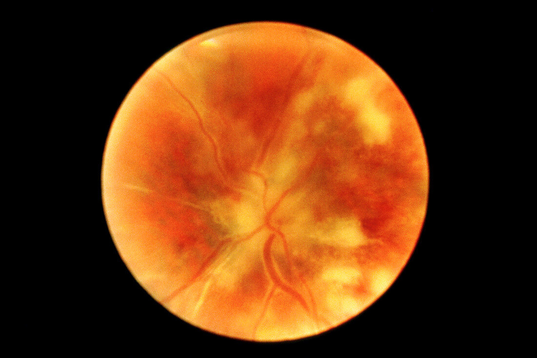 Chorioretinitis of the eye