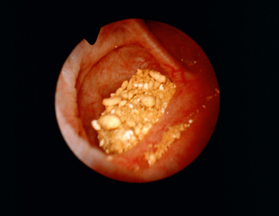 Endoscopic view of urinary bladder showing stones