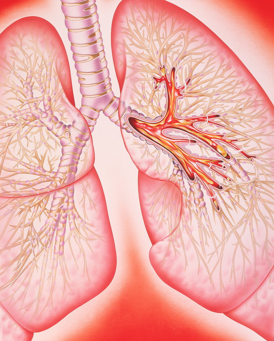 Lungs with bronchitis