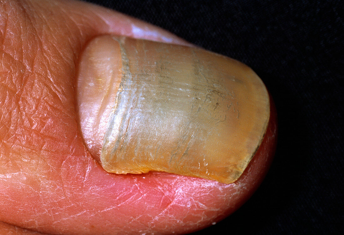Yellow nail