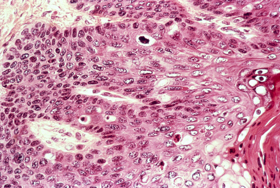 Bowen's disease,light micrograph
