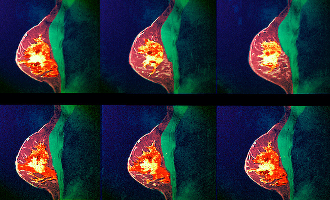 Breast cancer,MRI scans