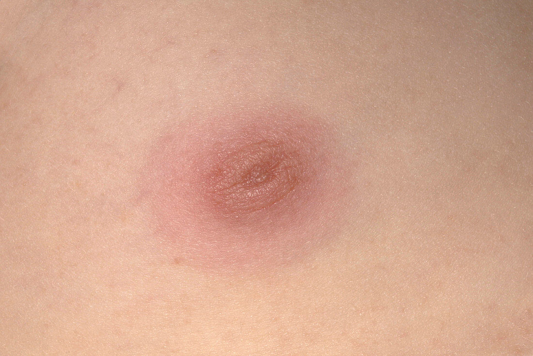 Nipple inflammation