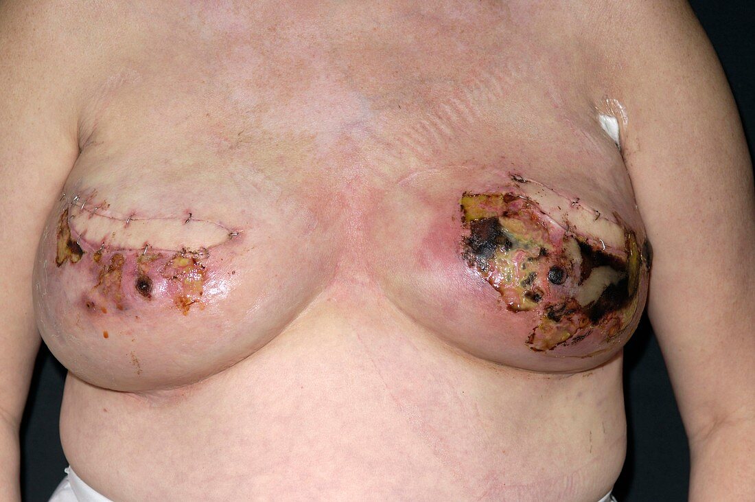 Infection following breast cancer surgery