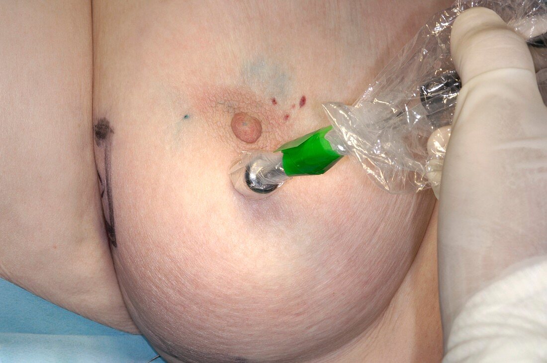 Breast cancer surgery