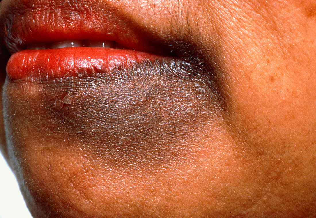 Chloasma (liver spot) affecting a woman's chin