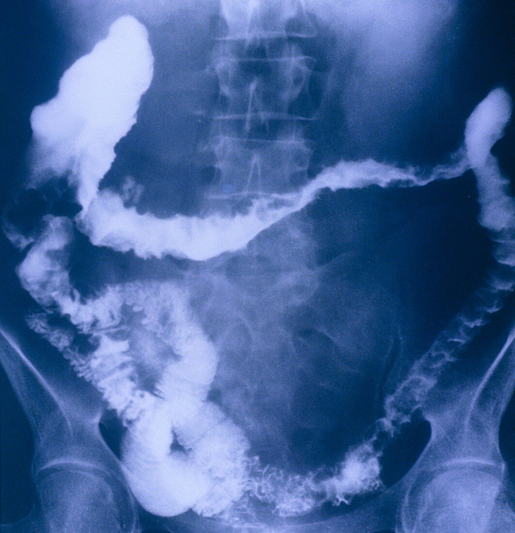 X-ray of colon in chronic ulcerative colitis