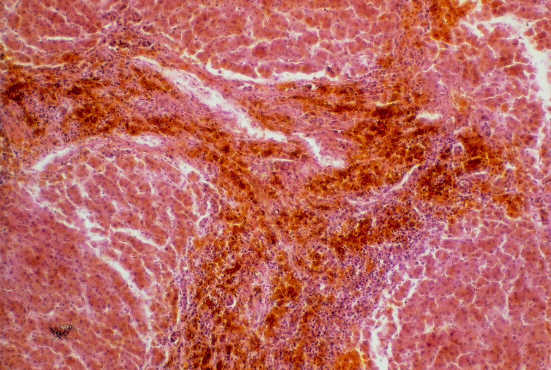 LM of human liver showing alcoholic cirrhosis