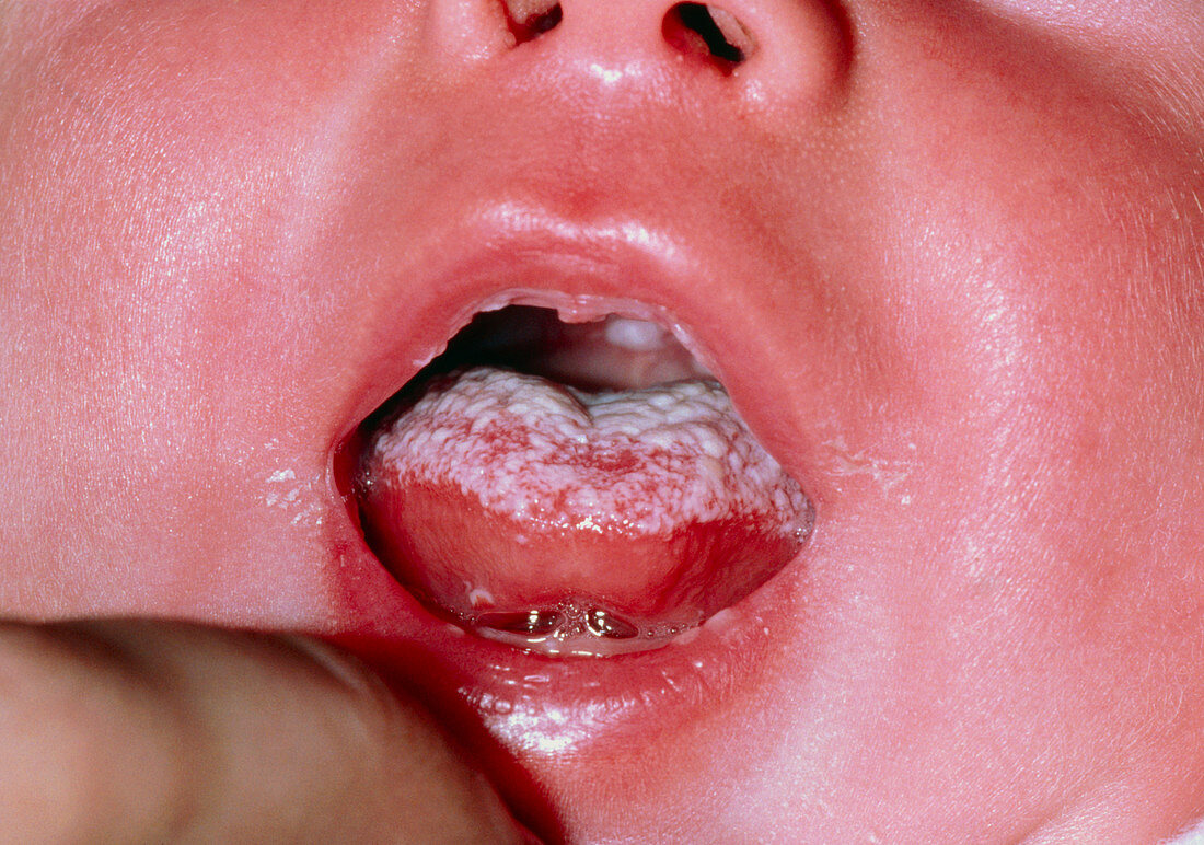 Oral candidiasis (thrush) in an infant