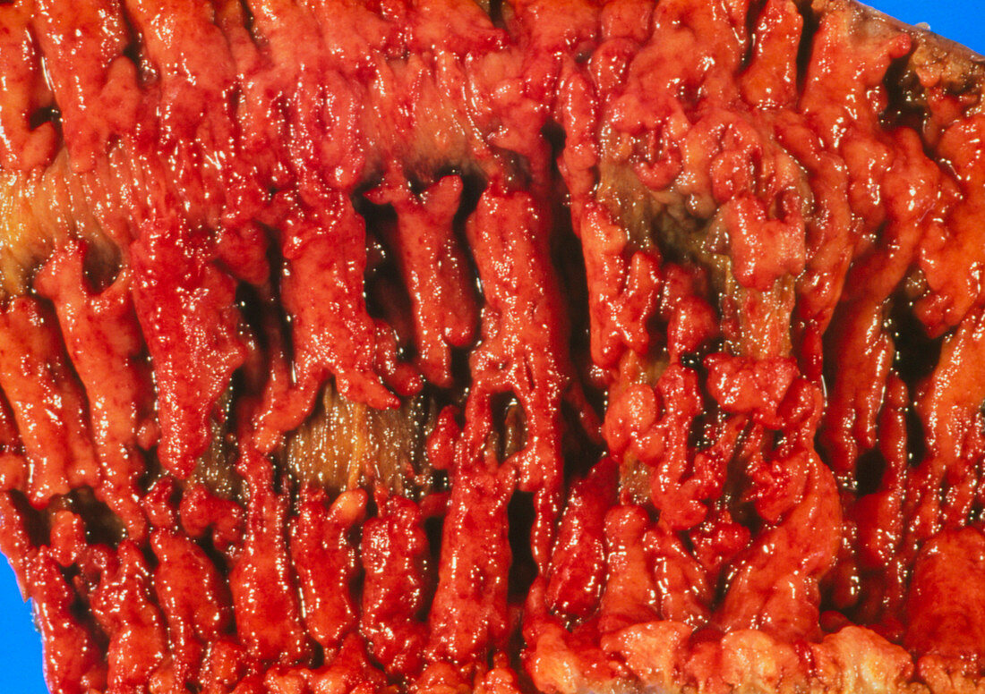 Excised human colon showing ulcerative colitis