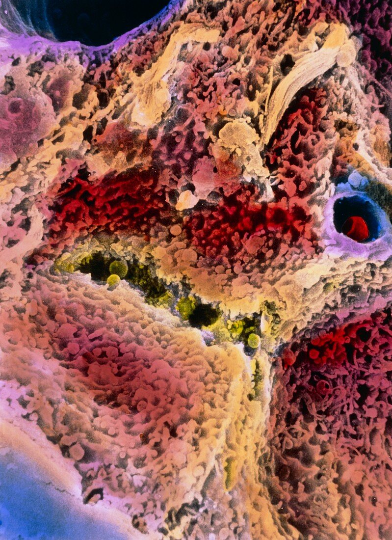 Coloured SEM of liver tissue with cirrhosis