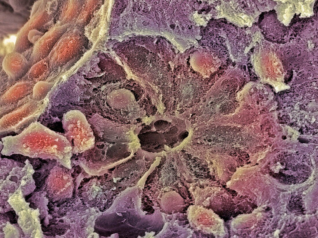 Breast cancer SEM