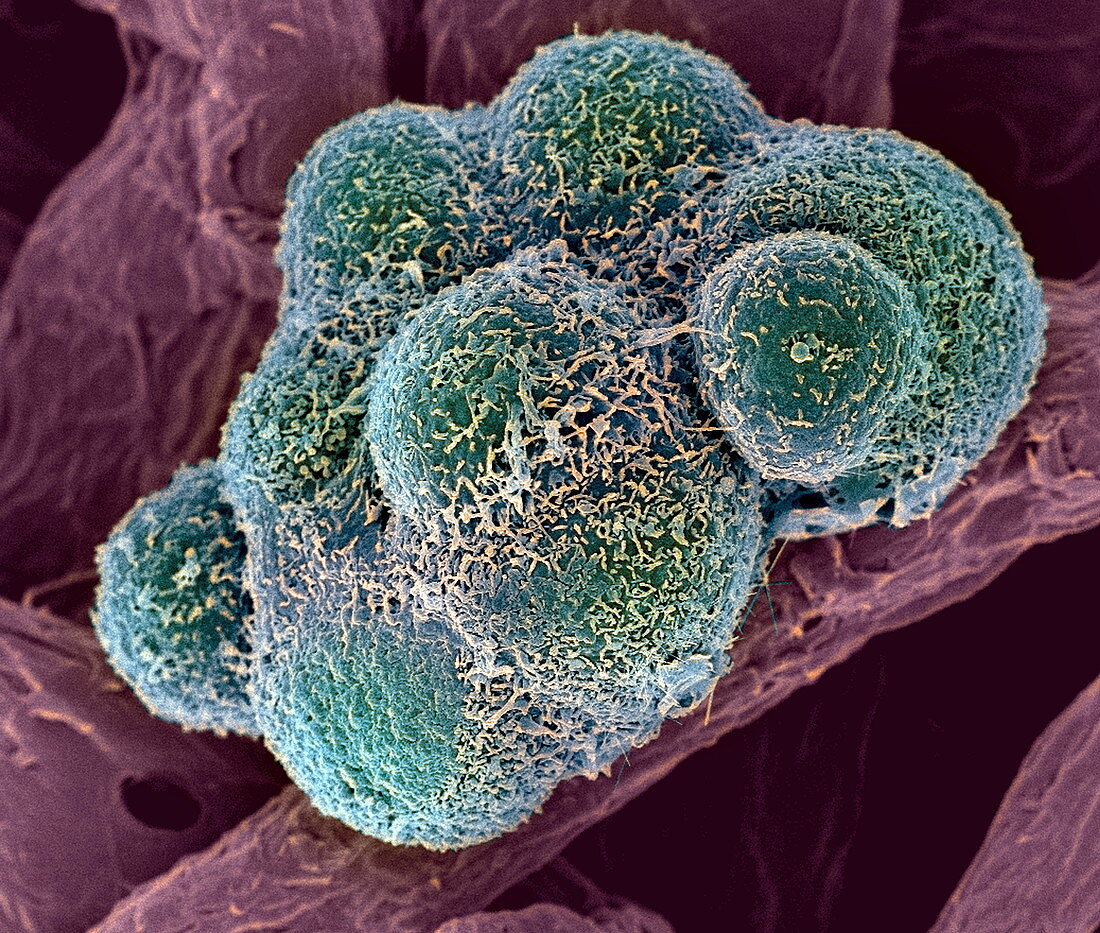 Breast cancer cells,SEM