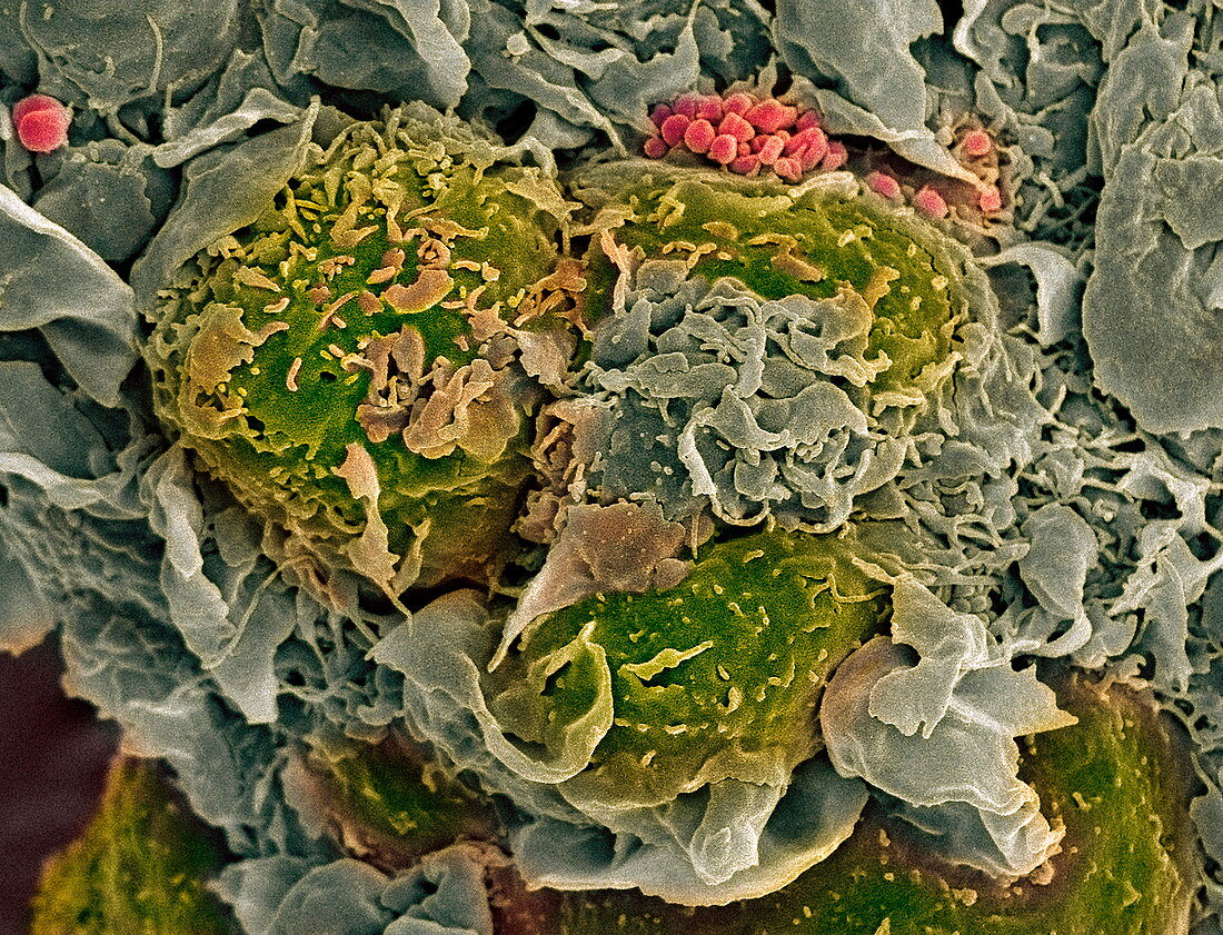 Breast cancer cells,SEM