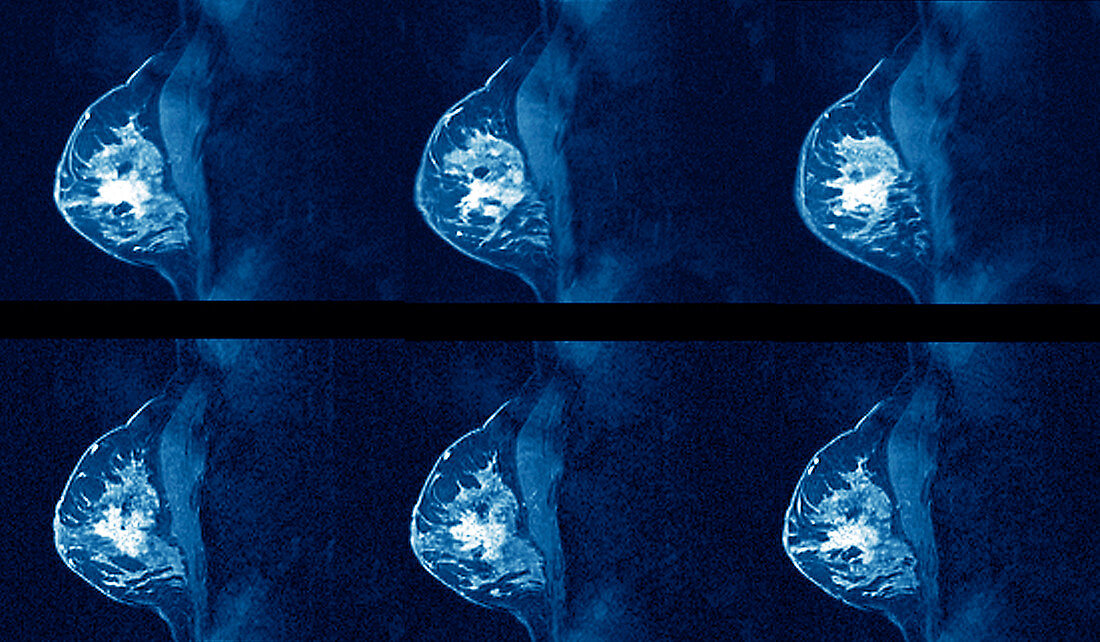Breast cancer,MRI scans