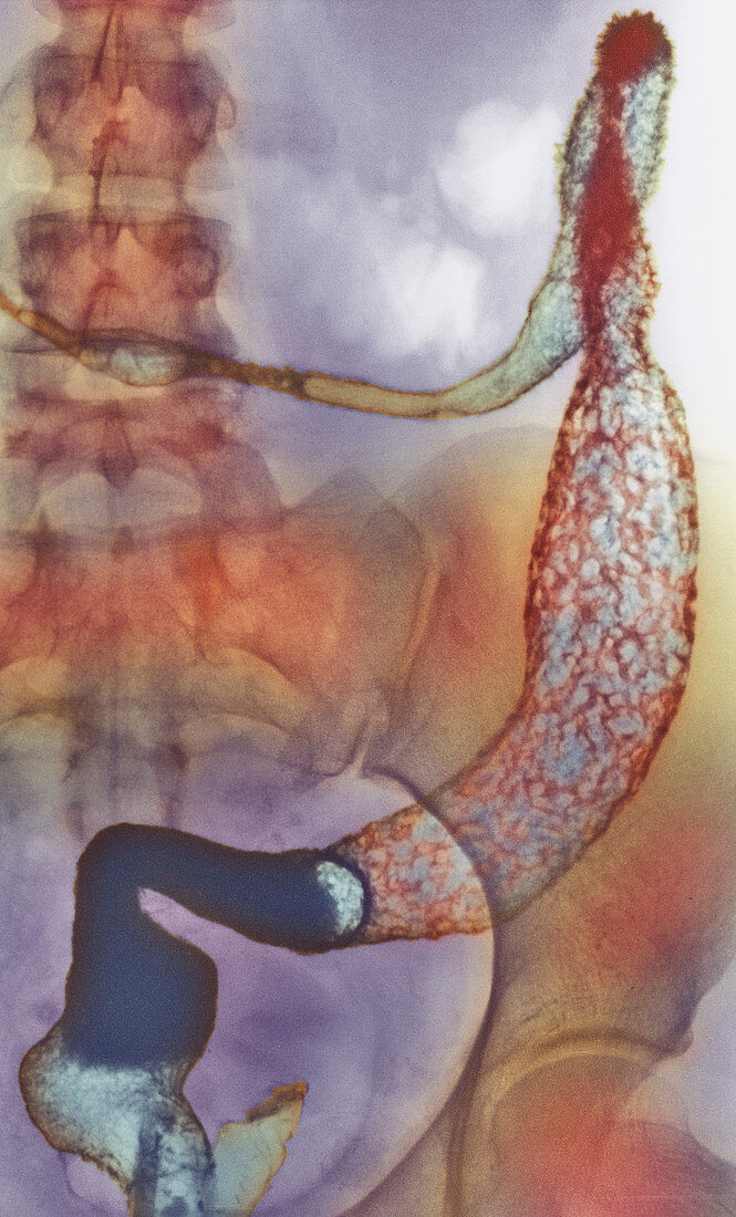 Ulcerative colitis X-ray