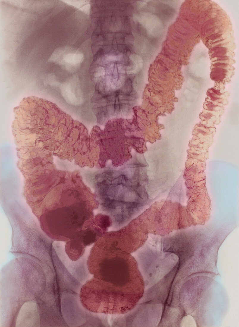 Ulcerative colitis X-ray