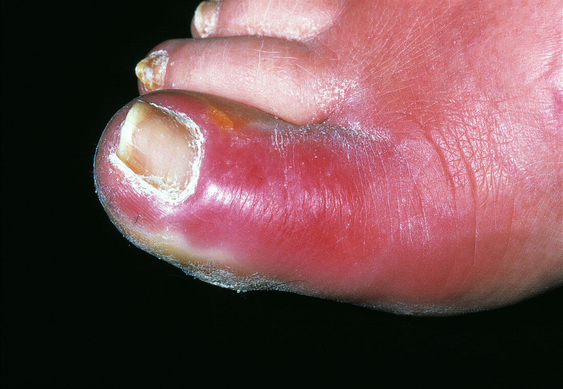Skin infection on toe
