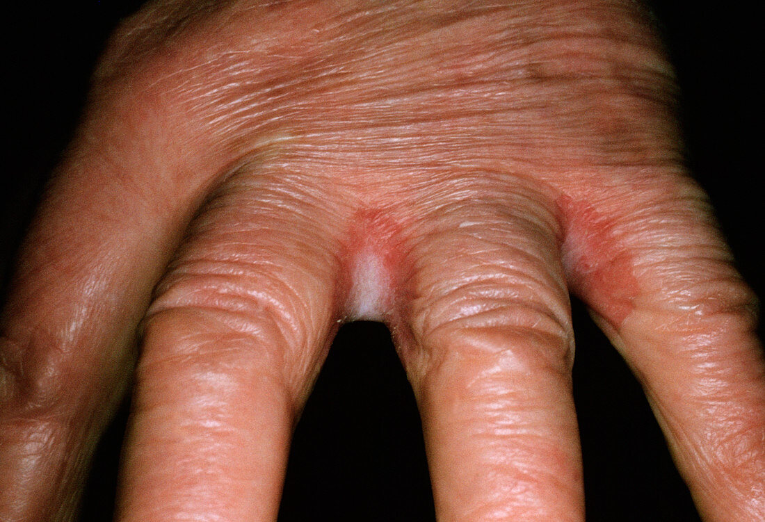 Candidiasis skin infection