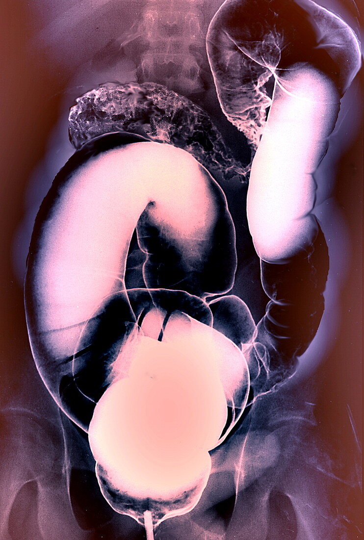 Crohn's disease,X-ray