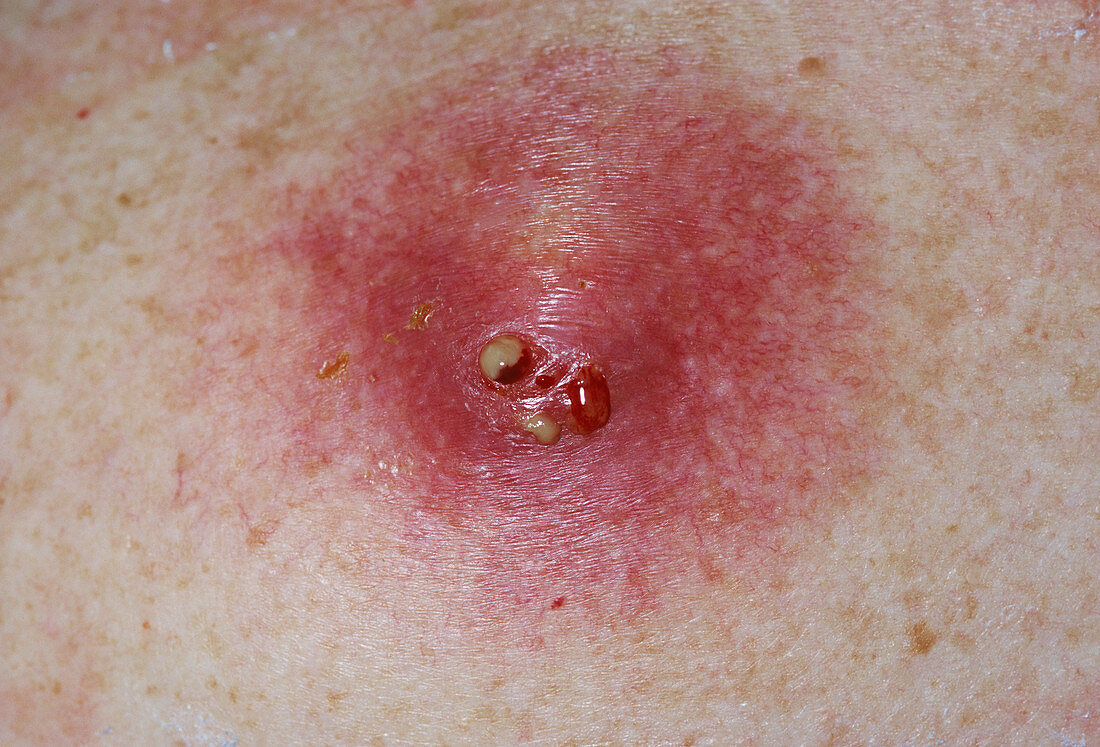 Infected cyst
