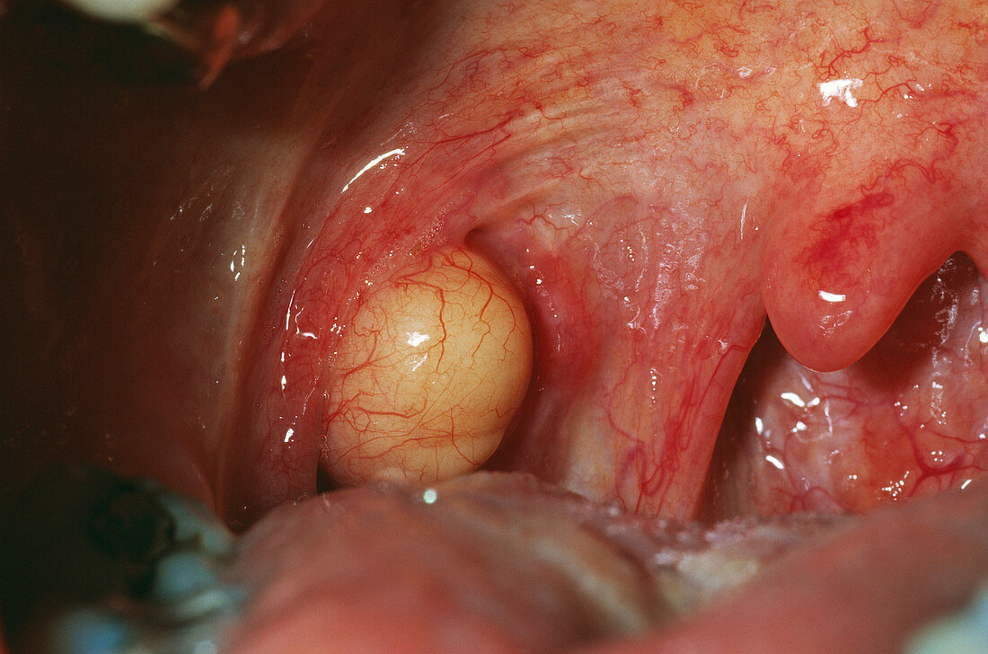 Mucous retention cyst