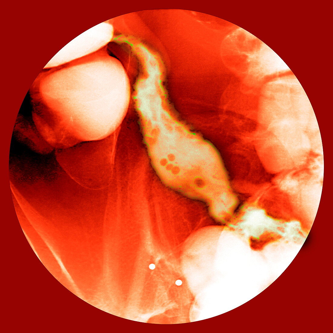 Crohn's disease,X-ray
