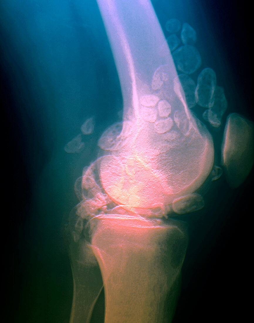 Benign bone tumours,X-ray