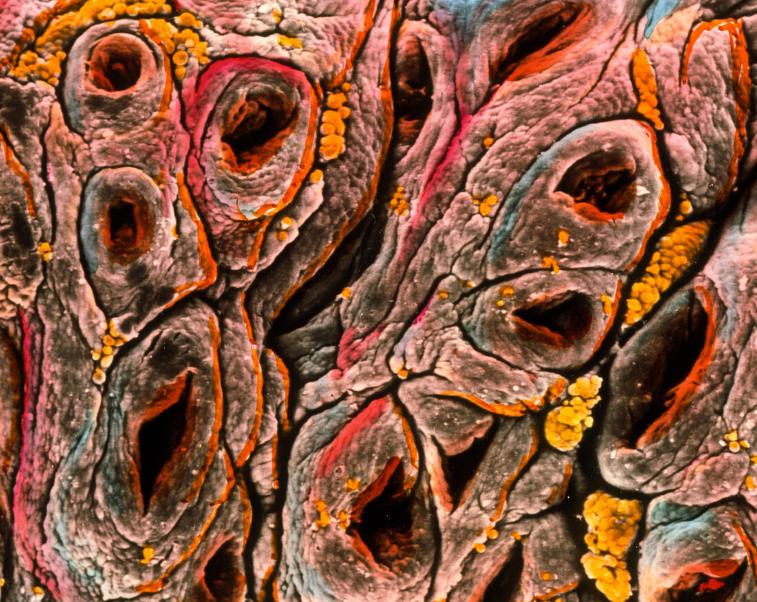 SEM of intestine showing coeliac disease