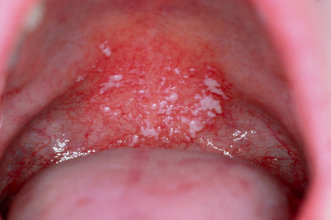Oral thrush due to corticosteroid drugs for asthma