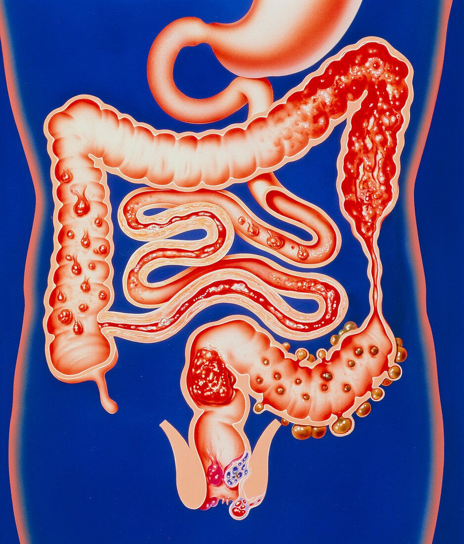 Artwork showing a range of intestinal diseases