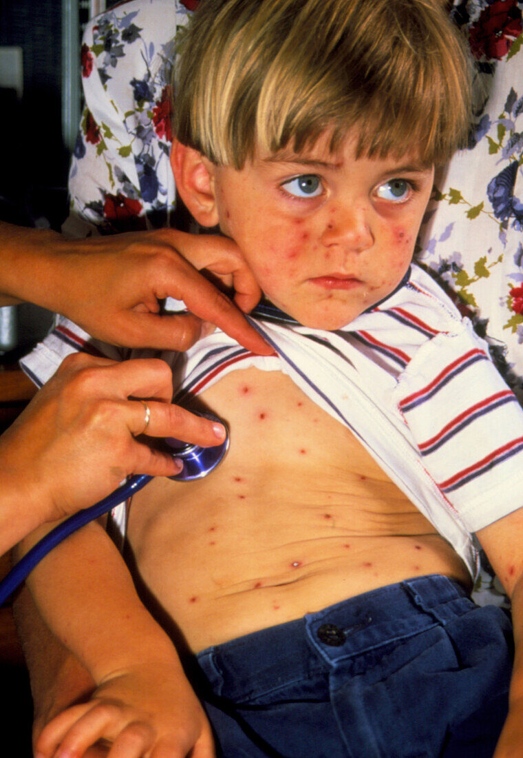 Boy,aged 3,affected by chickenpox