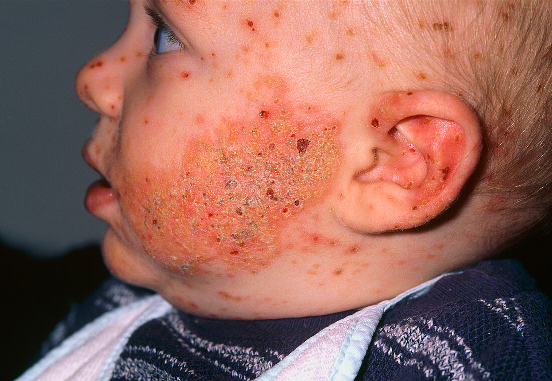 Chickenpox and eczema on the face of a baby boy