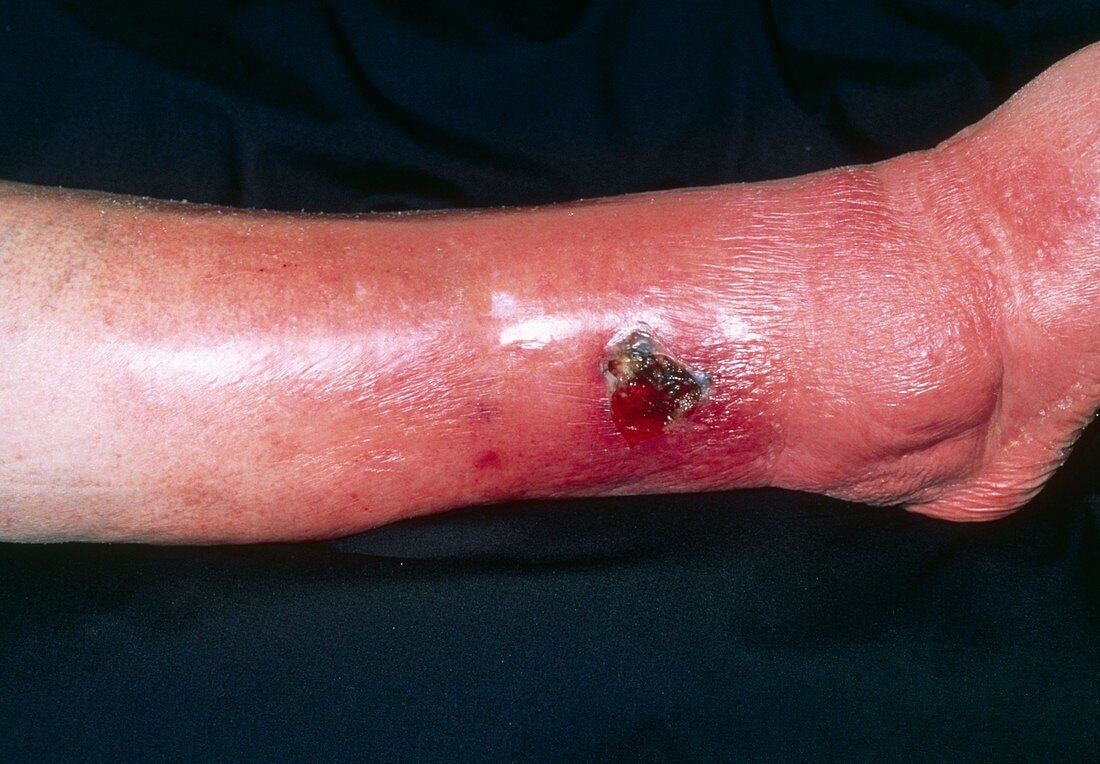 Cellulitis due to varicose ulcer of the leg