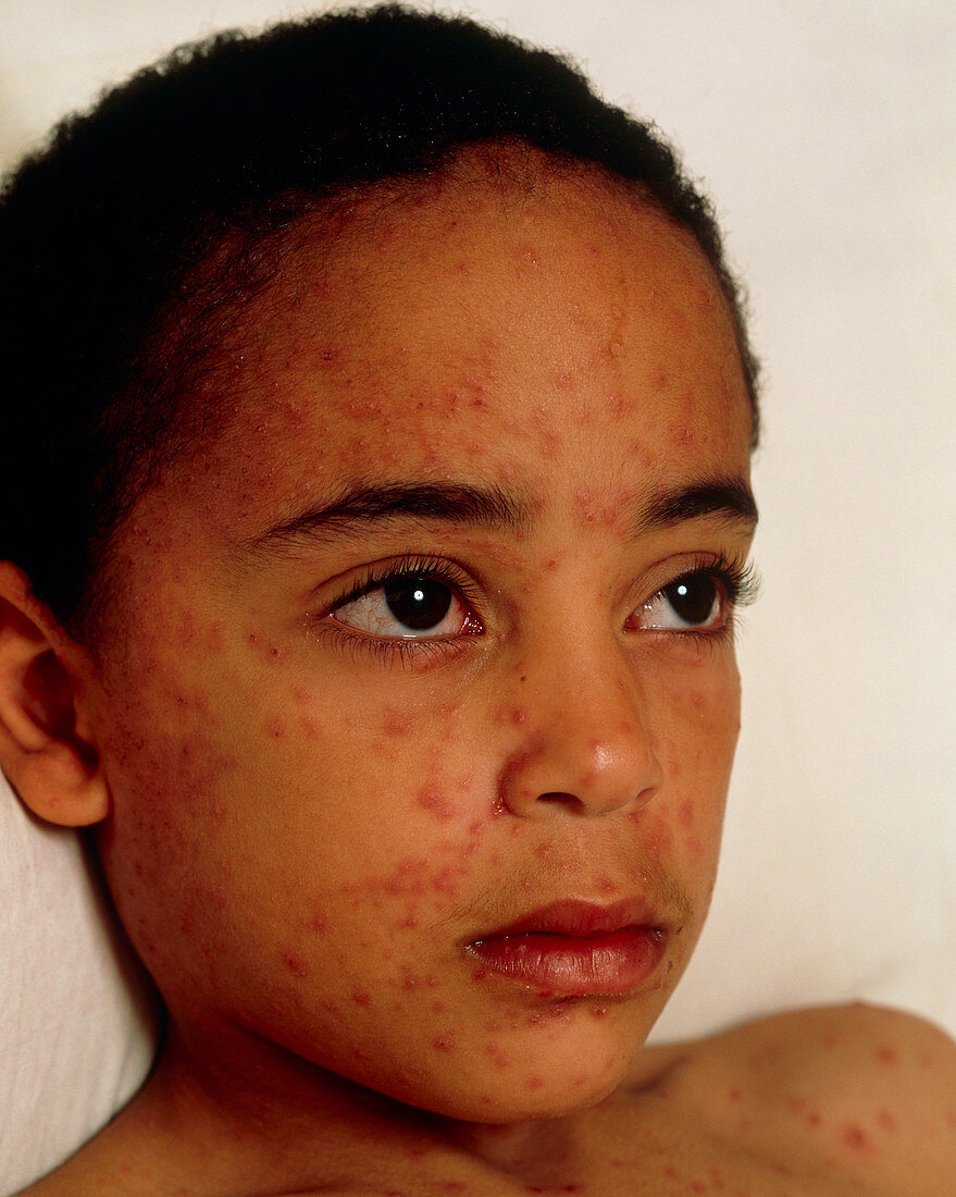 Chickenpox on the face of a young boy