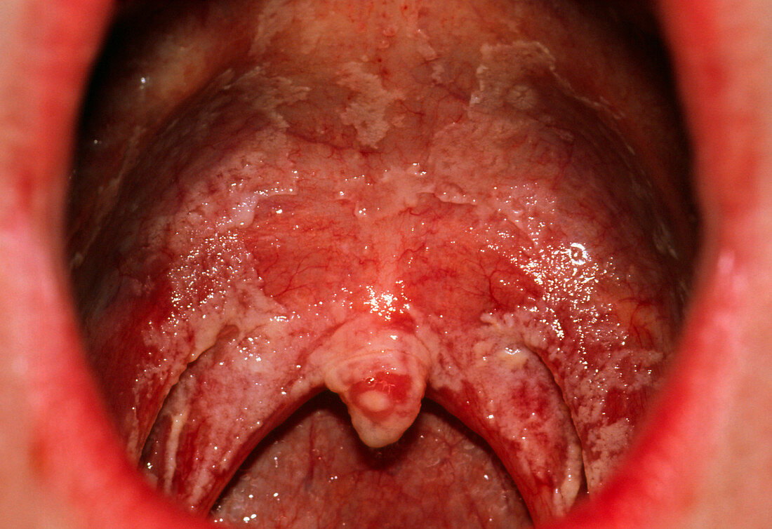 Oral thrush in asthma patient on inhaled steroids