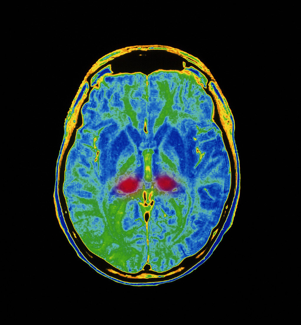 MRI scan of human brain diseased with CJD