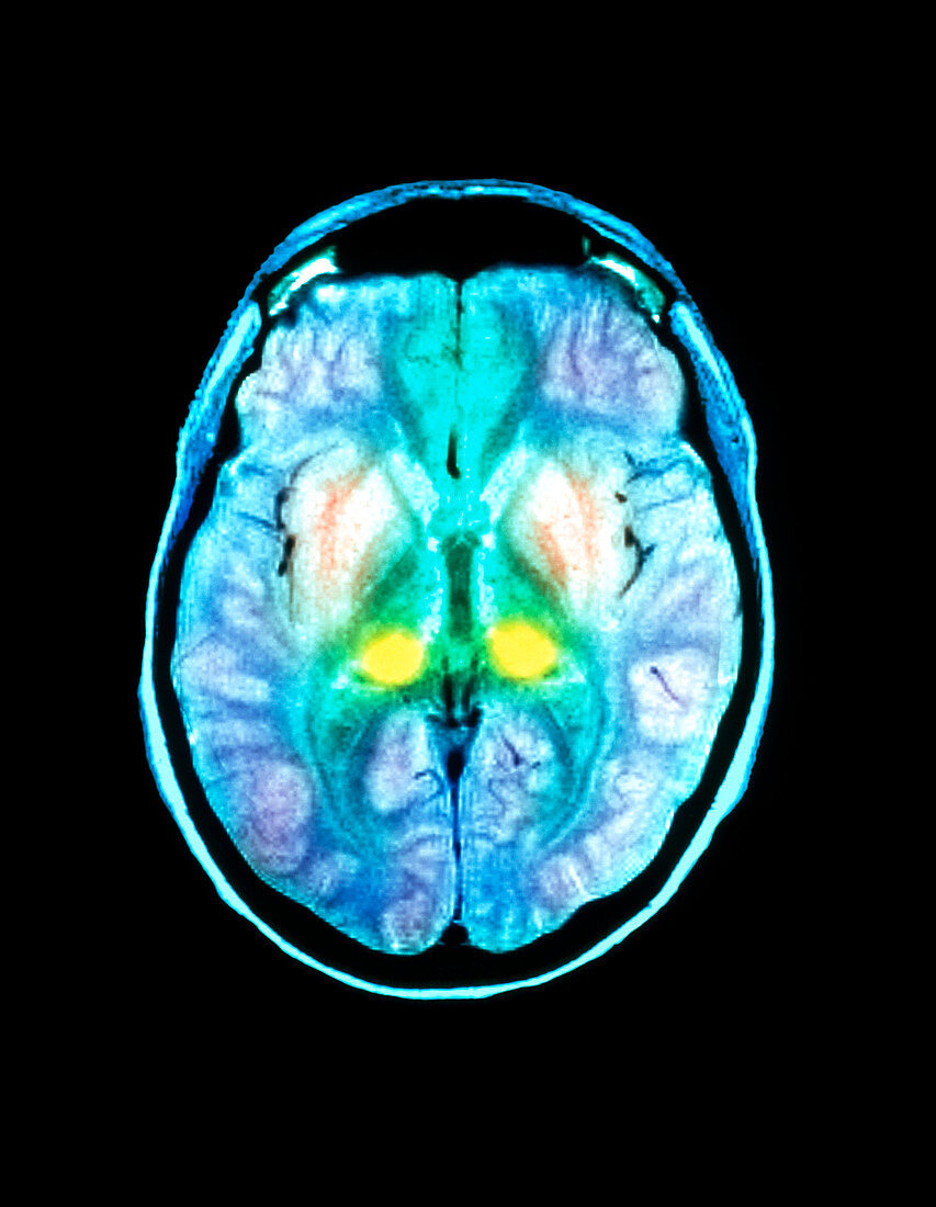 CJD brain,MRI scan