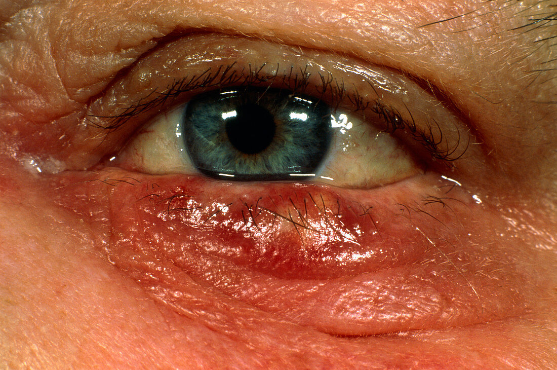 Stye (hordeolum) on patient's lower eyelid